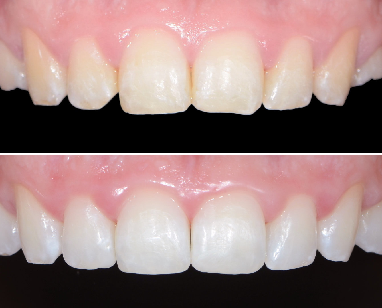 Brisbane Composite Bonding Le Tooth Brisbane Composite Bonding Le Tooth